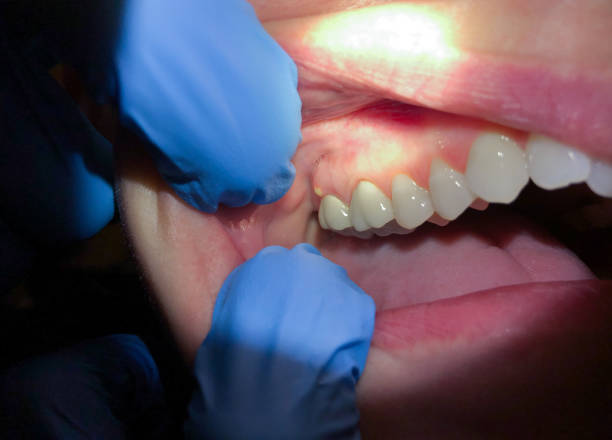Best Emergency Gum Treatment in Bennettsville, SC