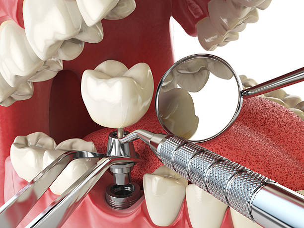 Best Urgent Care for Lost Fillings or Crowns in Bennettsville, SC